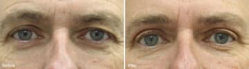 Upper Eyelid Surgery Before and After Photos in Princeton, NJ, Patient 981