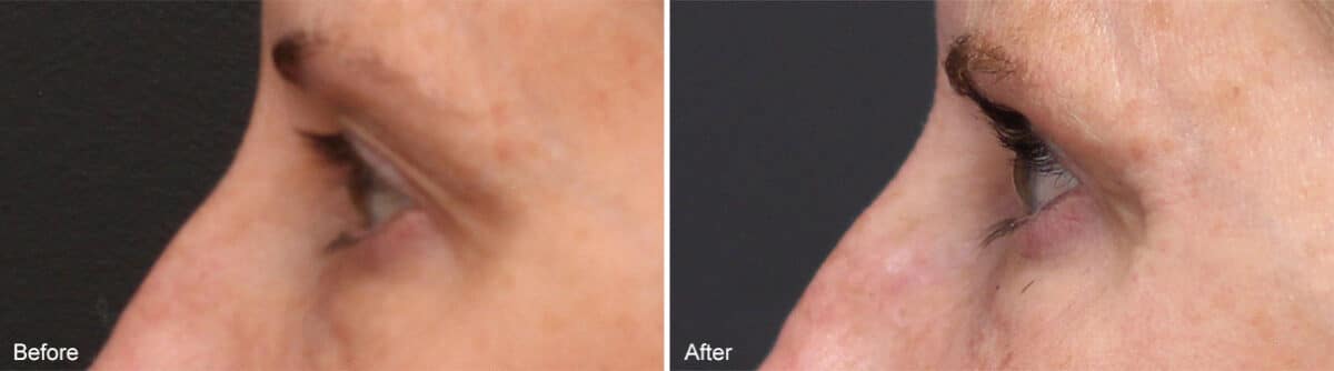 Upper Eyelid Surgery Before and After Photos in Princeton, NJ, Patient 1041