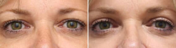 Upper Eyelid Surgery Before and After Photos in Princeton, NJ, Patient 1052