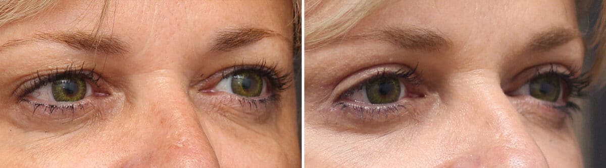 Upper Eyelid Surgery Before and After Photos in Princeton, NJ, Patient 1052