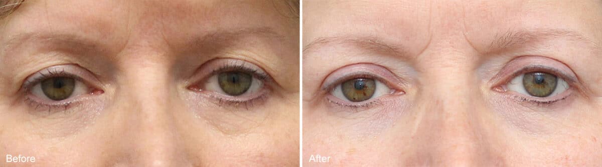 Upper Eyelid Surgery Before and After Photos in Princeton, NJ, Patient 1062