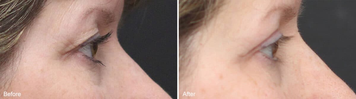 Upper Eyelid Surgery Before and After Photos in Princeton, NJ, Patient 1062