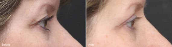 Upper Eyelid Surgery Before and After Photos in Princeton, NJ, Patient 1062