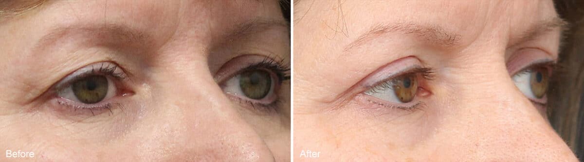 Upper Eyelid Surgery Before and After Photos in Princeton, NJ, Patient 1062