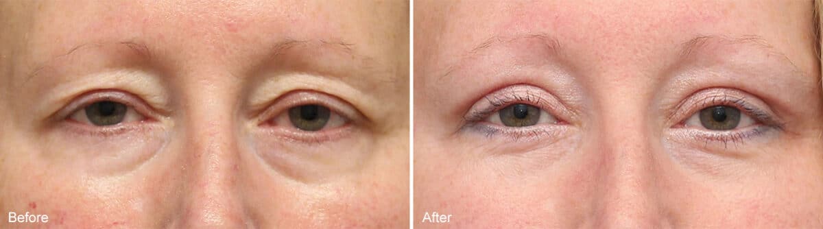 Upper Eyelid Surgery Before and After Photos in Princeton, NJ, Patient 1072