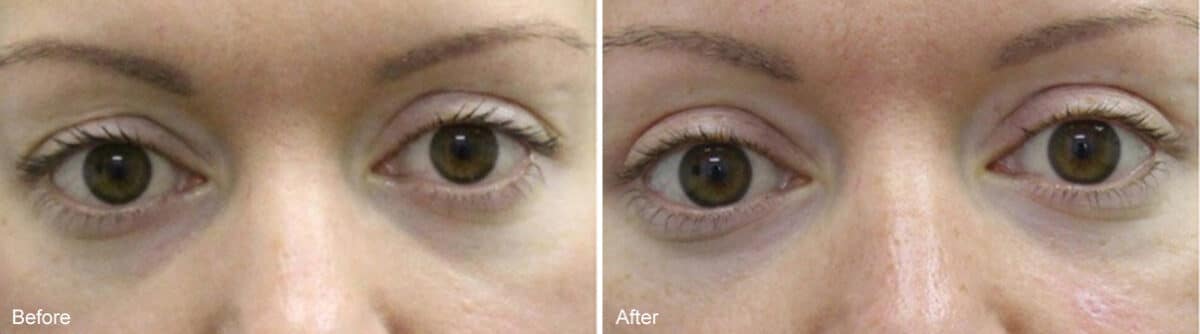 Upper Eyelid Surgery Before and After Photos in Princeton, NJ, Patient 985