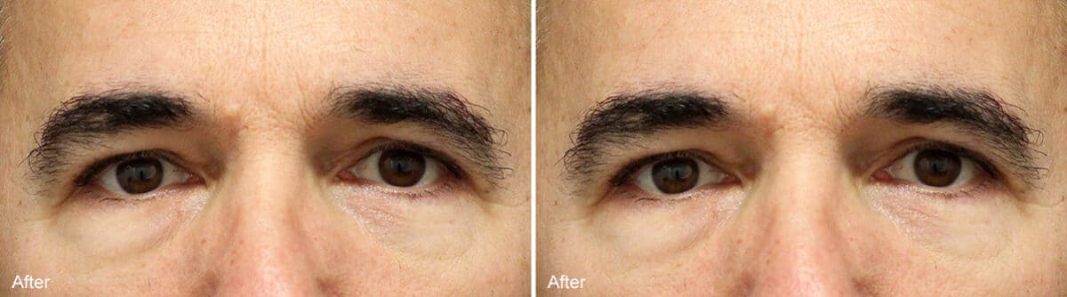 Upper Eyelid Surgery Before and After Photos in Princeton, NJ, Patient 1089