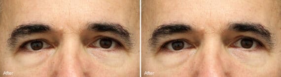 Upper Eyelid Surgery Before and After Photos in Princeton, NJ, Patient 1089