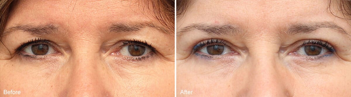 Upper Eyelid Surgery Before and After Photos in Princeton, NJ, Patient 1079