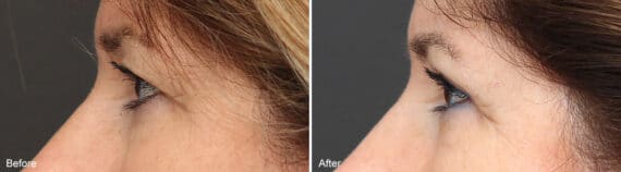 Upper Eyelid Surgery Before and After Photos in Princeton, NJ, Patient 1079