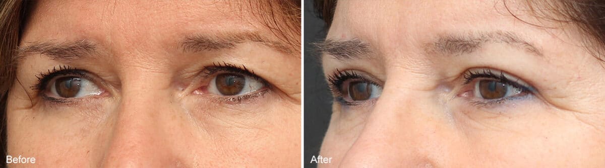 Upper Eyelid Surgery Before and After Photos in Princeton, NJ, Patient 1079