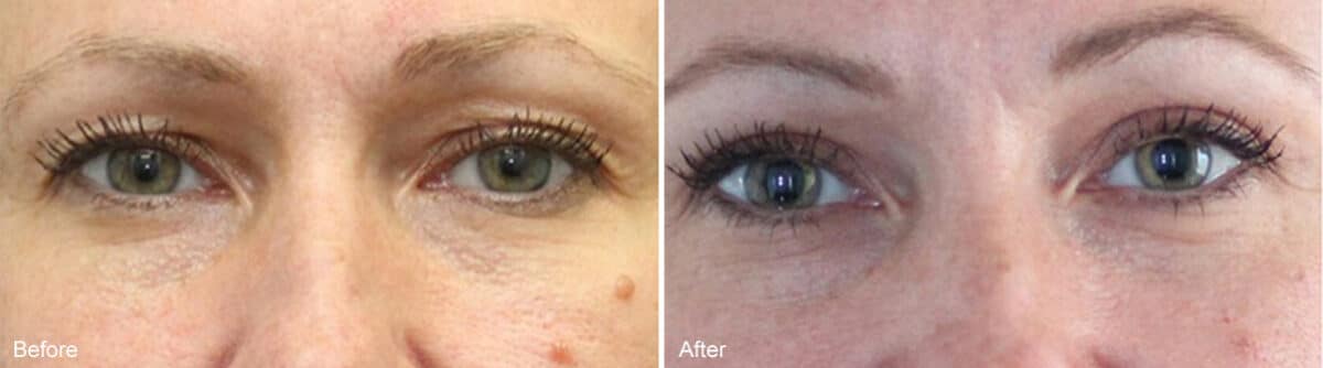 Upper Eyelid Surgery Before and After Photos in Princeton, NJ, Patient 989