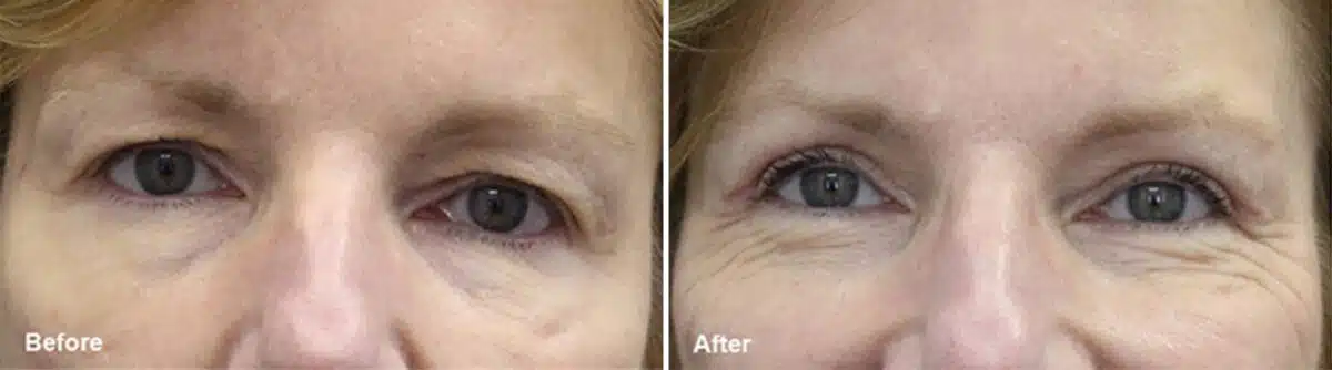 Upper Eyelid Surgery Before and After Photos in Princeton, NJ, Patient 993