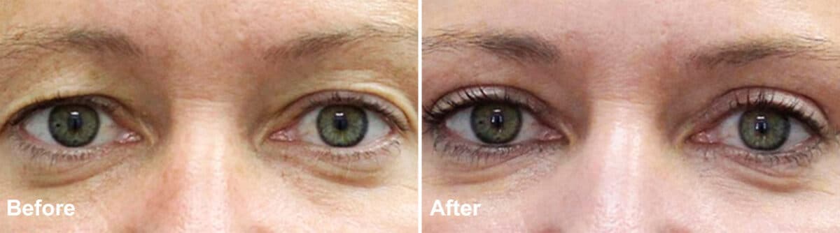 Upper Eyelid Surgery Before and After Photos in Princeton, NJ, Patient 997