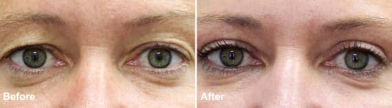 Upper Eyelid Surgery Before and After Photos in Princeton, NJ, Patient 997