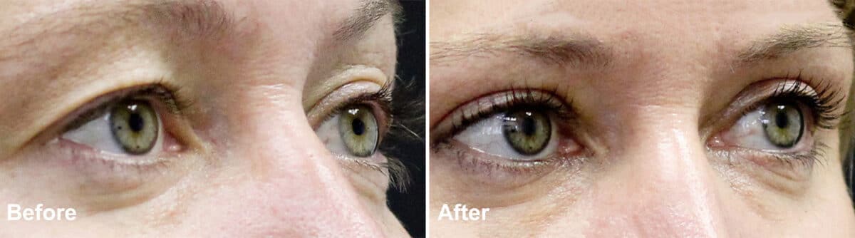 Upper Eyelid Surgery Before and After Photos in Princeton, NJ, Patient 997