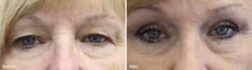 Upper Eyelid Surgery Before and After Photos in , , Patient 1004