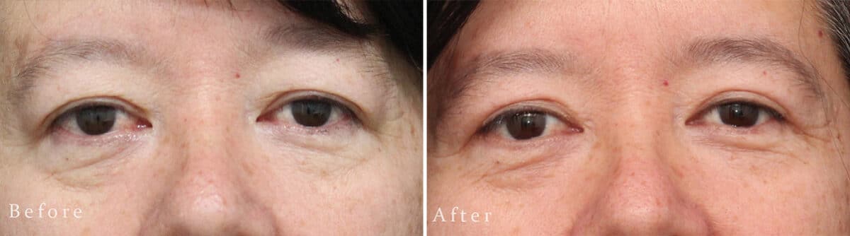 Upper Eyelid Surgery Before and After Photos in Princeton, NJ, Patient 1009