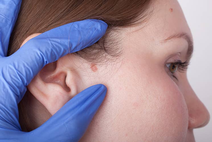 Skin cancer is a disease that is most likely to appear in people with fair skin