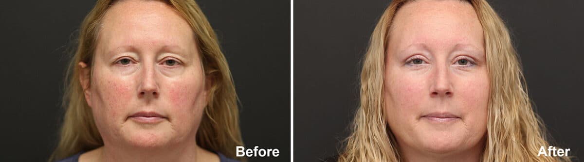 Laser Treatments Before and After Photos in Princeton, NJ, Patient 1176