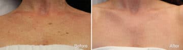 Laser Treatments Before and After Photos in Princeton, NJ, Patient 1180