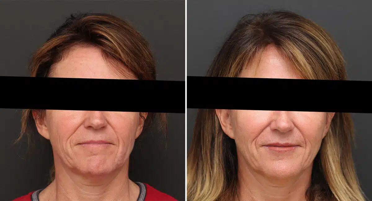 Instalift Before and After Photos in Princeton, NJ, Patient 1185