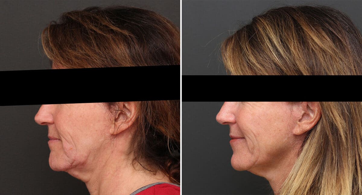 Instalift Before and After Photos in Princeton, NJ, Patient 1185