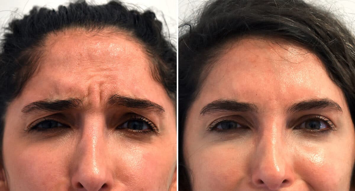 Botox Before and After Photos in Philadelphia, PA, Patient 1526