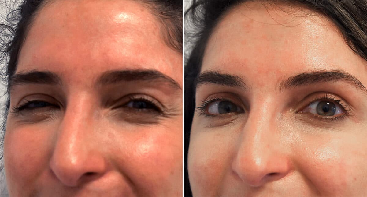 Botox Before and After Photos in Philadelphia, PA, Patient 1526