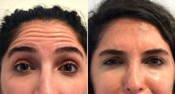 Botox Before and After Photos in Philadelphia, PA, Patient 1526