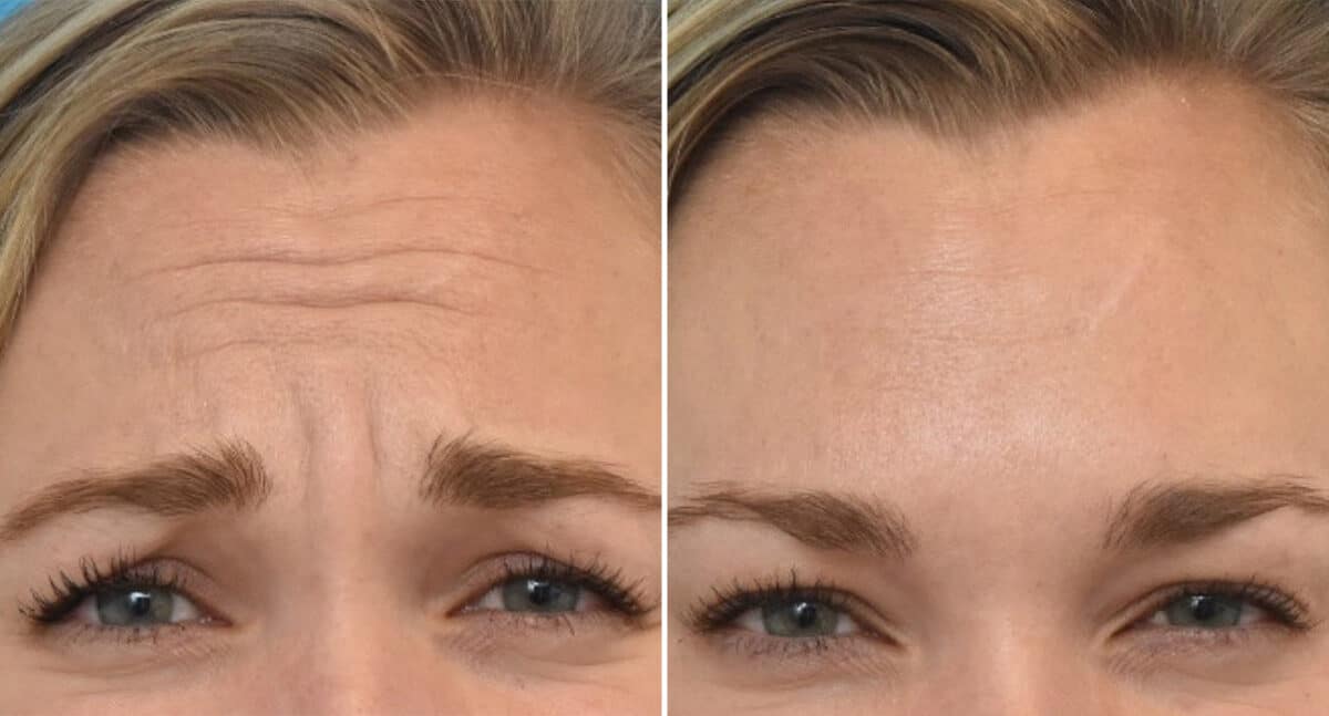 Botox Before & After Photos, Patient Photo, Pictures