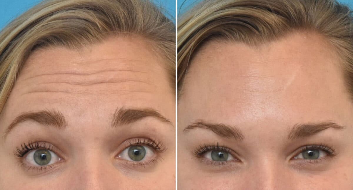 Botox Before and After Photos in Philadelphia, PA, Patient 1540