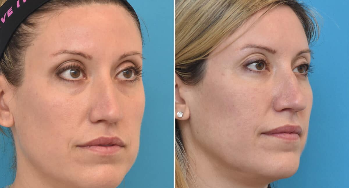 Injectable Fillers Before and After Photos in Philadelphia, PA, Patient 1547