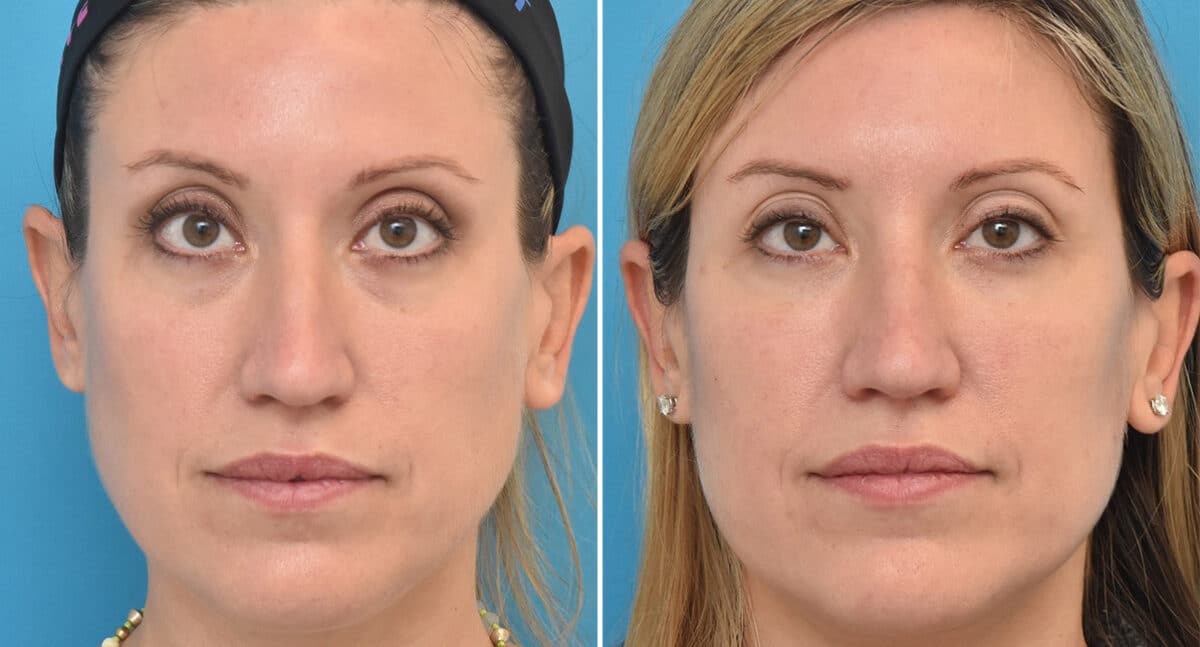 Injectable Fillers Before and After Photos in Philadelphia, PA, Patient 1547