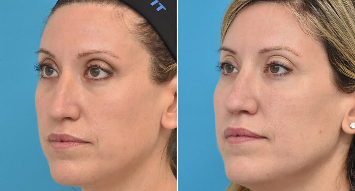 Injectable Fillers Before and After Photos in Philadelphia, PA, Patient 1547