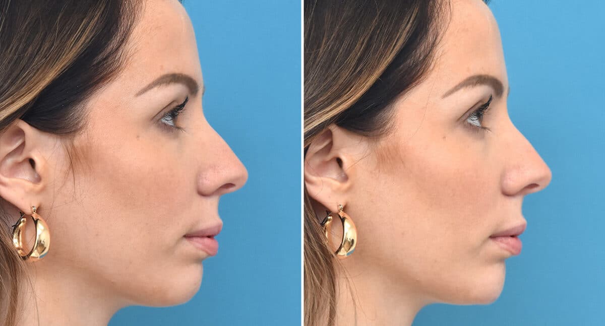 Injectable Fillers Before and After Photos in Philadelphia, PA, Patient 1557