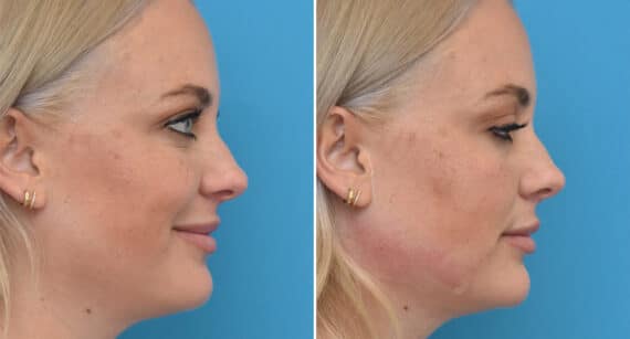 Injectable Fillers Before and After Photos in Philadelphia, PA, Patient 1564