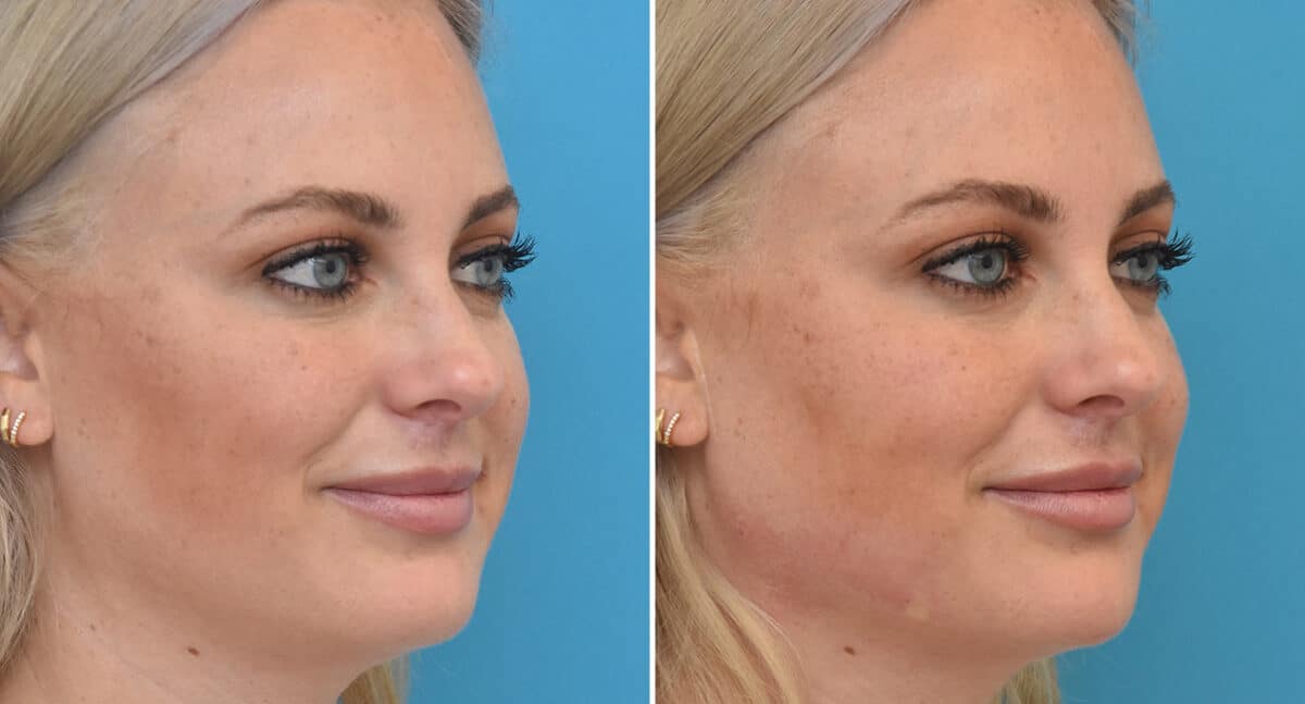 Injectable Fillers Before and After Photos in Philadelphia, PA, Patient 1564