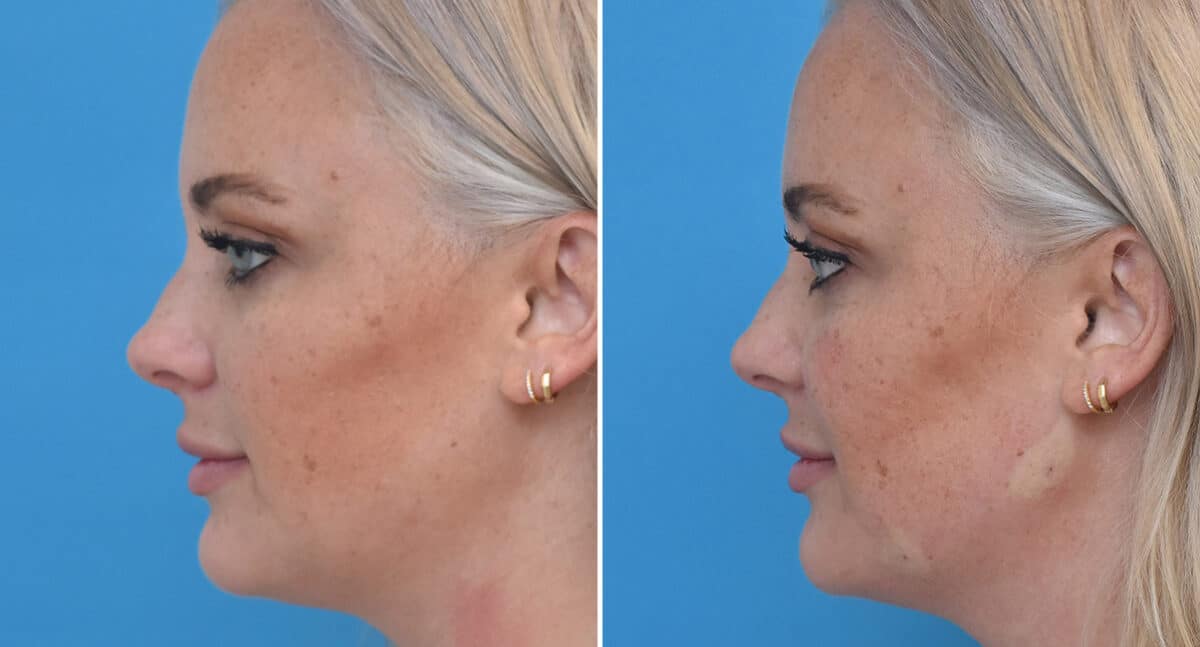 Injectable Fillers Before and After Photos in Philadelphia, PA, Patient 1564