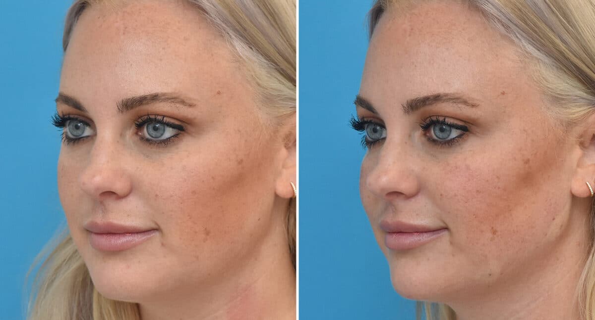 Injectable Fillers Before and After Photos in Philadelphia, PA, Patient 1564