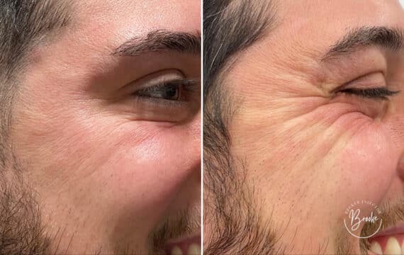 Botox Before and After Photos in Philadelphia, PA, Patient 2831