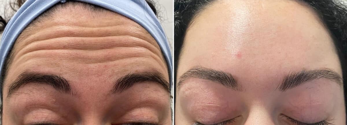 Botox Before and After Photos in Philadelphia, PA, Patient 2839