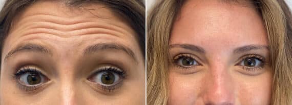 Botox Before and After Photos in Philadelphia, PA, Patient 2847