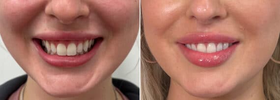 Botox Before and After Photos in Philadelphia, PA, Patient 2851