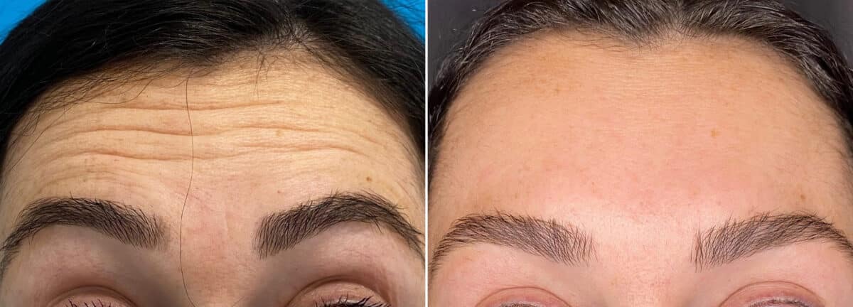 Botox Before and After Photos in Philadelphia, PA, Patient 2859