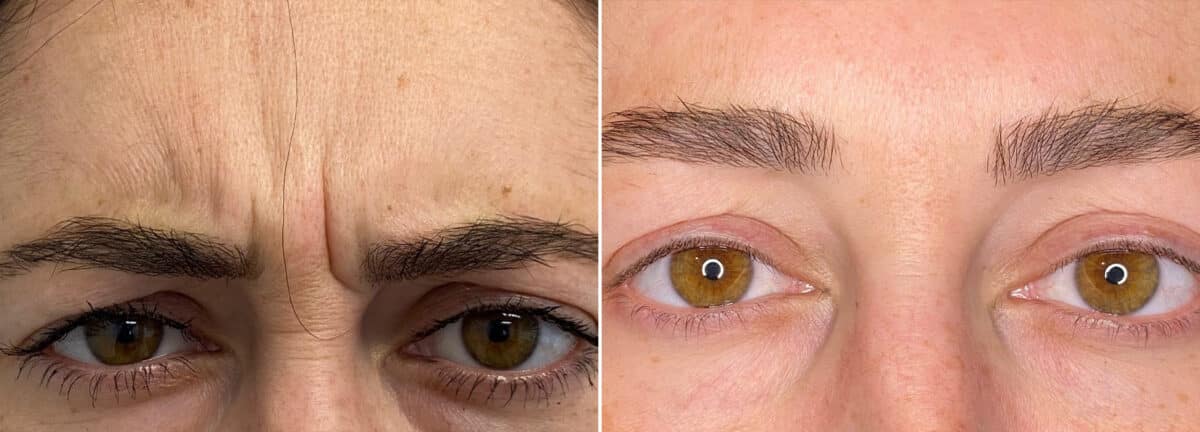 Botox Before and After Photos in Philadelphia, PA, Patient 2859