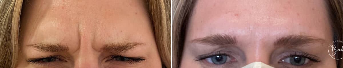 Botox Before and After Photos in Philadelphia, PA, Patient 2866