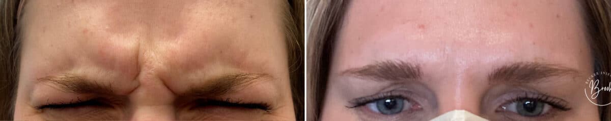 Botox Before and After Photos in Philadelphia, PA, Patient 2866