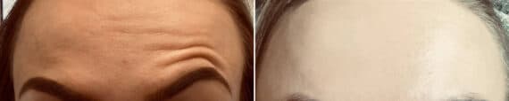 Botox Before and After Photos in Philadelphia, PA, Patient 2872