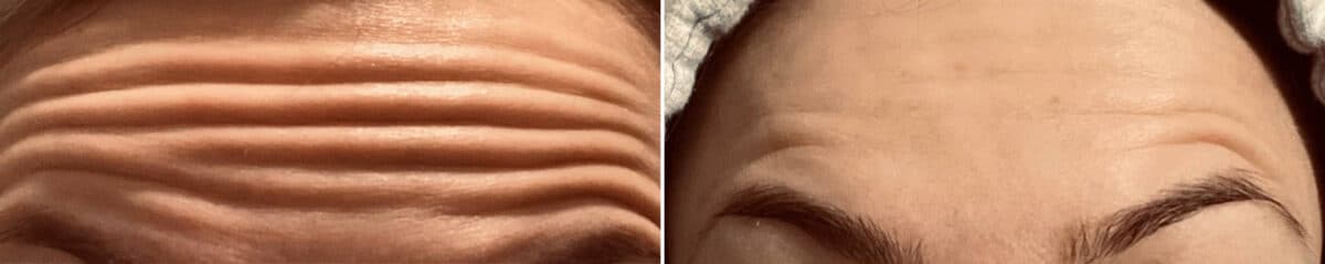 Botox Before and After Photos in Philadelphia, PA, Patient 2872